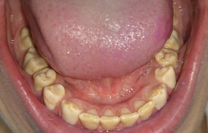 Choroby twardych tkanek zębów